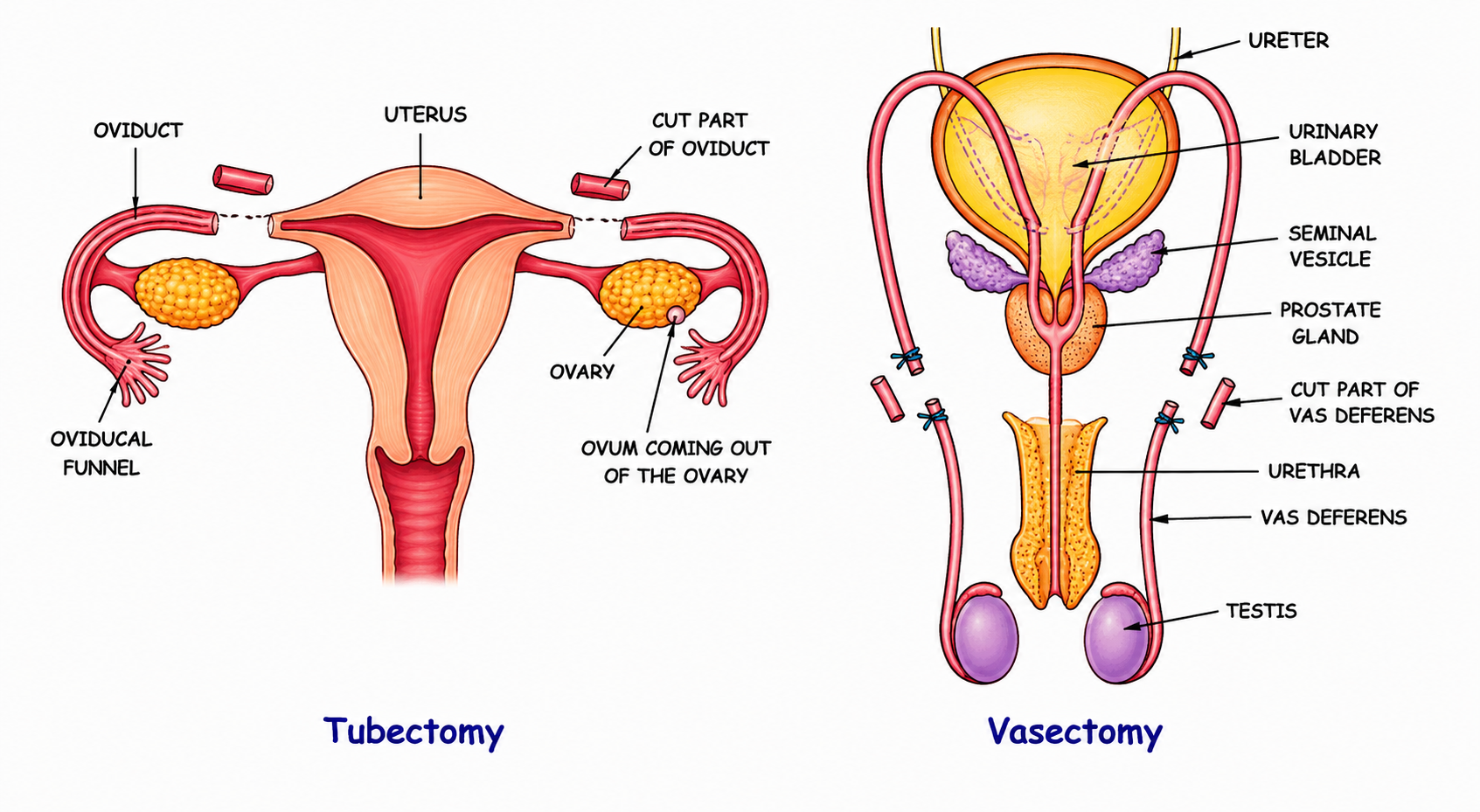 Fig. 12.5 Tubectomy and Figure 12.6 Vasectomy combined
